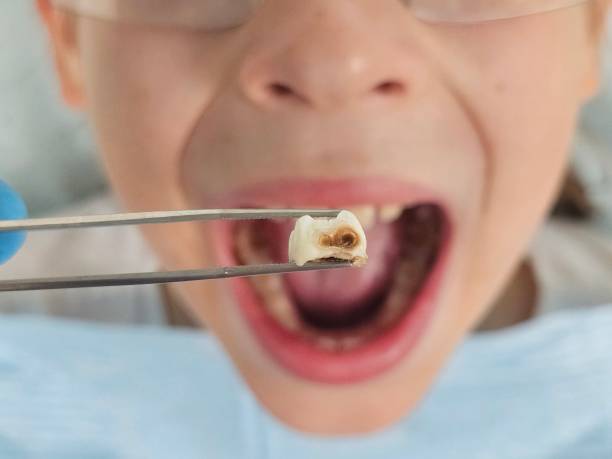 Best After-Hours Dental Trauma Care in Marion, MT