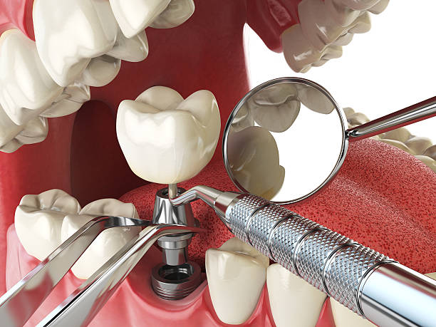 Best Emergency Treatment for Dental Infections or Abscesses in Marion, MT